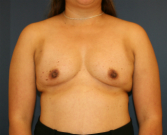 Feel Beautiful - Breast Augment 540cc saline - Before Photo